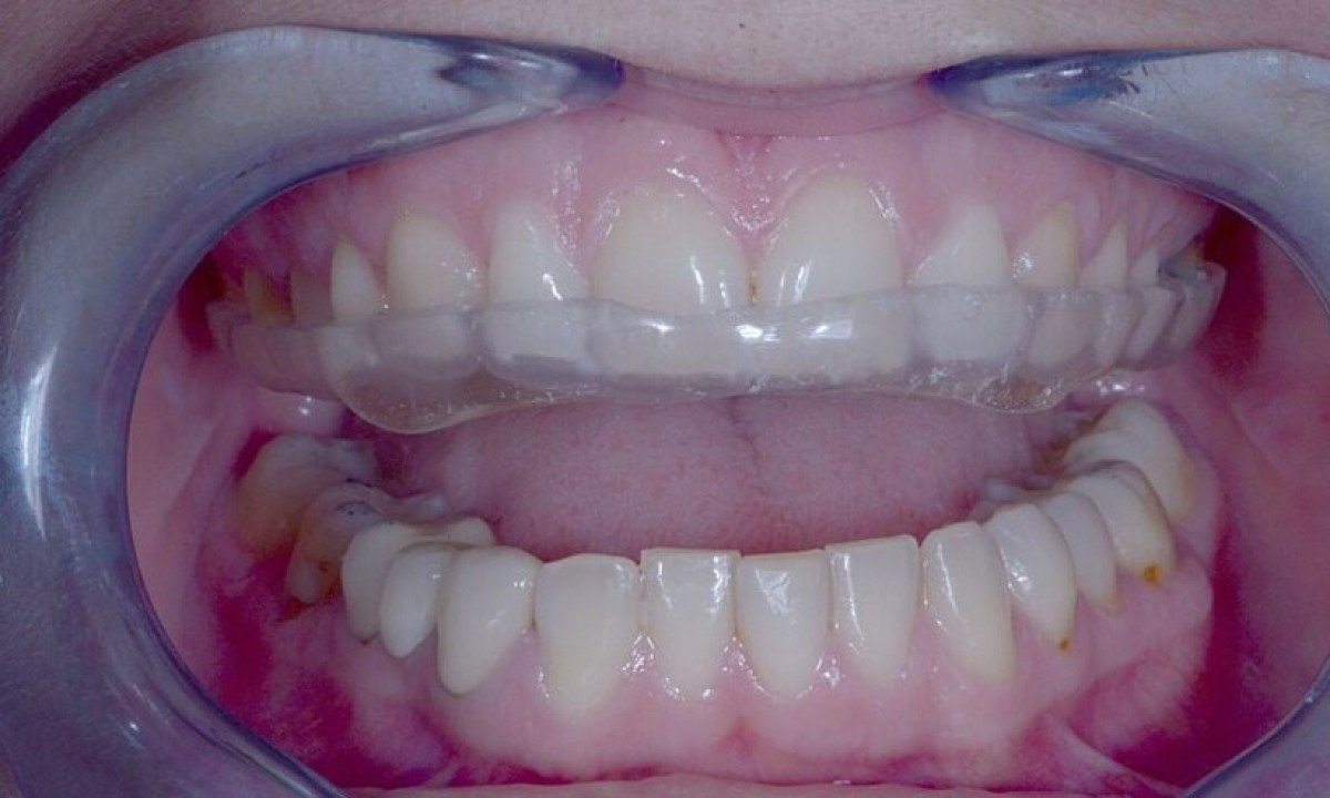 boca com aparelho contra bruxismo, separando os dentes -  (crédito: Wikimedia Common/Propdental)