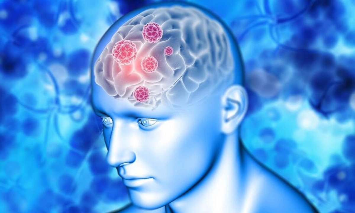 ilustração de um cérebro infectado - meningite -  (crédito: kjpargeter/Freepik)