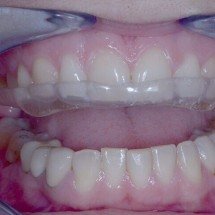 O impacto do estresse e da ansiedade: como lidar com o bruxismo no carnaval - Wikimedia Common/Propdental