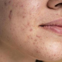  Mitos e verdades sobre a rosácea; descubra - Freepik