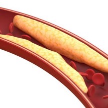Colesterol VLDL, LDL e HDL: qual a diferença?  - Freepik