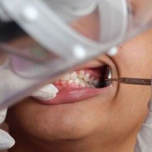 Implantes dentários: mitos, verdades e cuidados necessários - Laísa Queiroz/MS