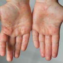 7 respostas para se proteger contra o sarampo, que volta a preocupar - Getty Images