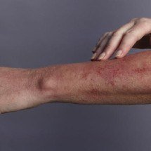 Urticária crônica: Minas Gerais debate novo protocolo de tratamento