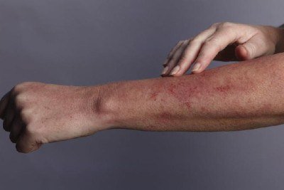 Urticária -  (crédito: Getty Images)
