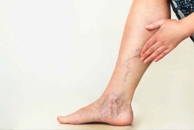Pernas femininas com varizes -  (crédito: Guia da Farmácia/reprodução )