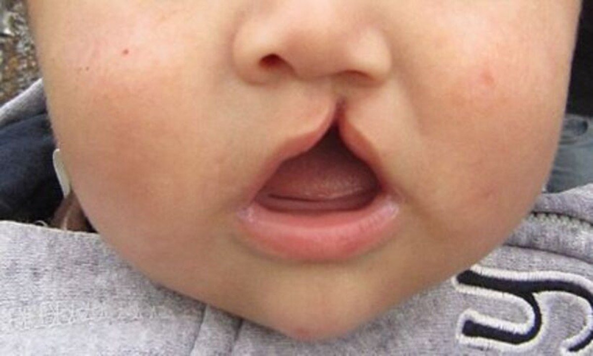 bebê com lábio leporino