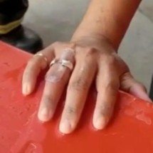 Jovem com dedo estrangulado por anel é socorrida por bombeiros -  CBMMG