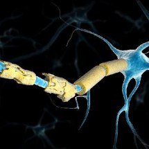 O que é mito e o que é verdade sobre a esclerose múltipla - Getty Images