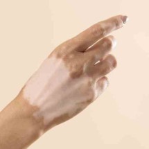 Dia Mundial do Vitiligo: data reforça atenção ao tratamento e acolhimento - Freepik