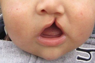bebê com lábio leporino -  (crédito: James Heilman.MD/Wikimedia Commons)