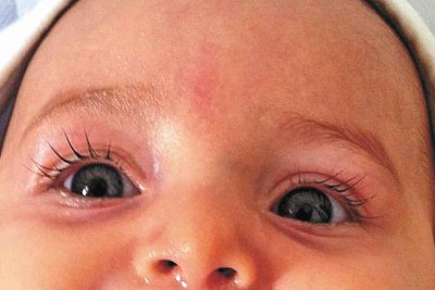 Conjuntivite neonatal -  (crédito: ellen cristie/em/d.a press)