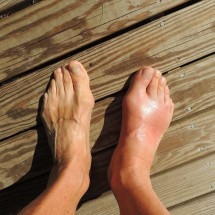 Diabético: saiba preservar a saúde dos pés e evitar risco de amputação - cnick/Pixabay