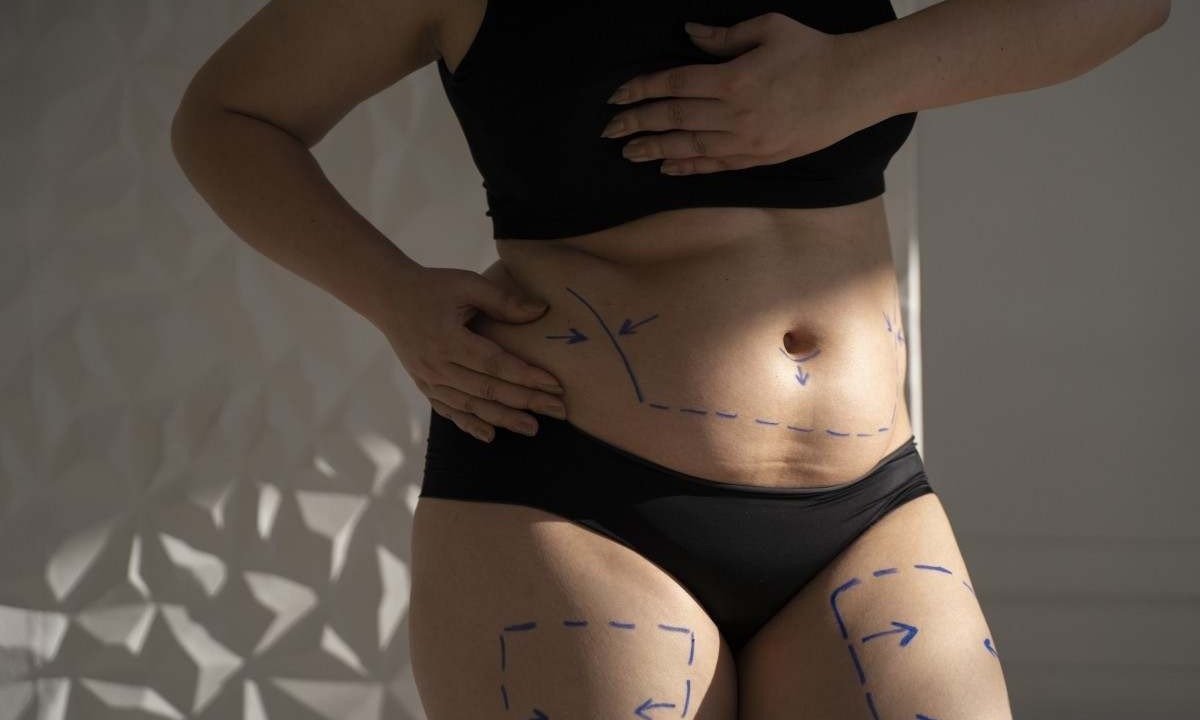 Outro ponto preocupante na prática da lipoaspiração é o aumento do uso de medicamentos para impedir hemorragias para facilitar a realização de vários procedimentos estéticos ao mesmo tempo -  (crédito: Freepik)