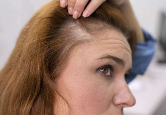 O medicamento foi aprovado para o tratamento da alopecia areata, doença autoimune que causa queda de cabelo -  (crédito: Reprodução/Freepik)