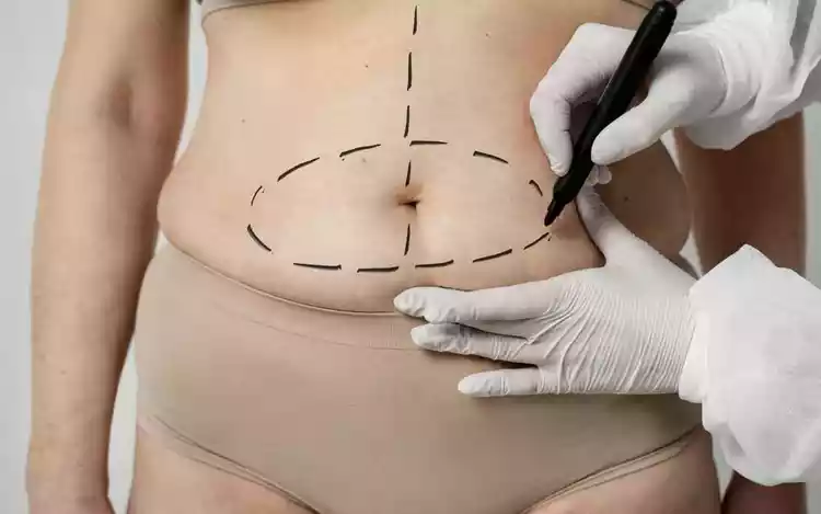 A Sociedade Brasileira de Cirurgia Plástica (SBCP) estima que 2 milhões de pessoas tenham feito lipoaspiração em 2023 -  (crédito:  lipoaspiração)