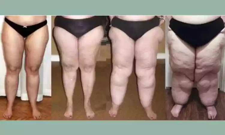 Lipedema: caracterizada pelo acúmulo desproporcional de gordura nas pernas e braços que resulta em dores nos membros afetados e que atinge quase que exclusivamente mulheres
 -  (crédito: SBACV/Divulgação)