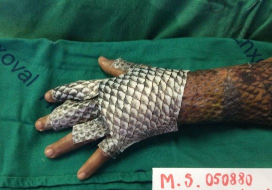 Pele de tilápia aplicada em paciente com queimaduras -  (crédito: Arquivo pessoal)