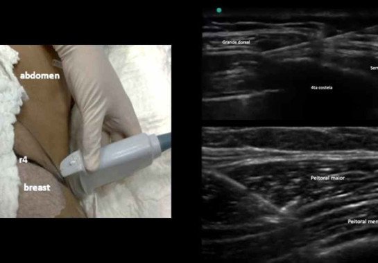 No procedimento, o aparelho de ultrassom (à esq.) localiza a região a ser bloqueada (à dir.) e, a seguir, o anestésico local é injetado com uma agulha, bloqueando a área e impedindo a sinalização da dor  -  (crédito: Márcio Matsumoto)