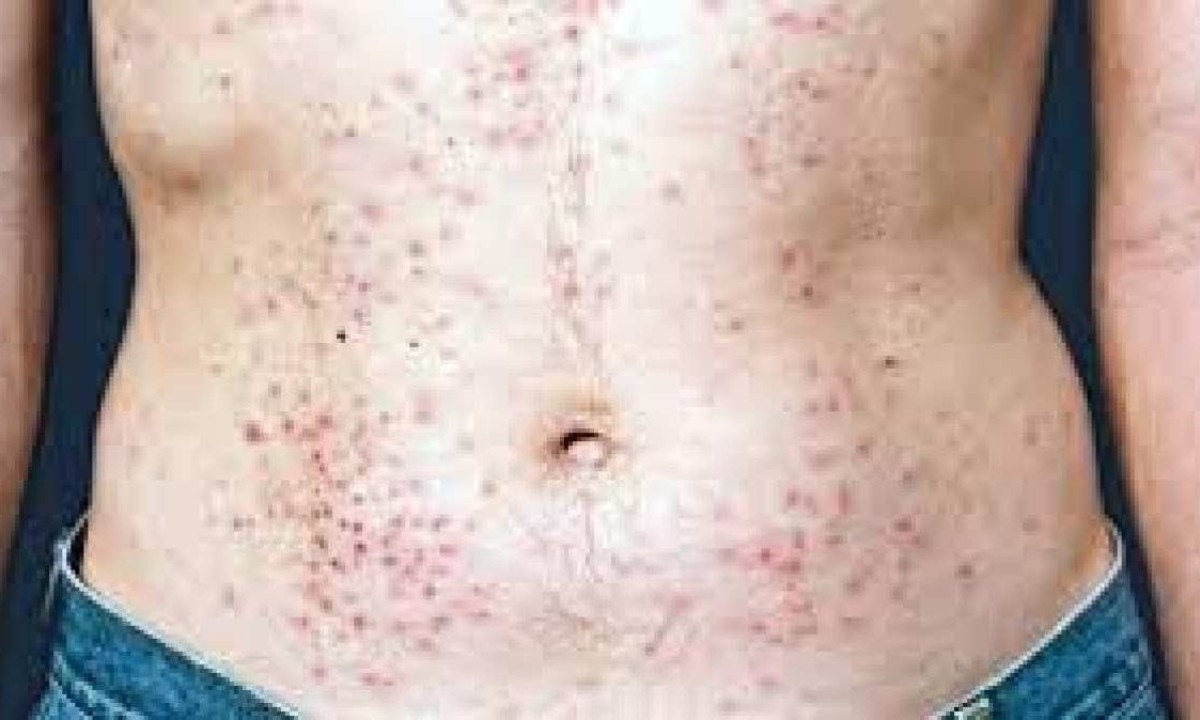 Lesão de pele provocada pelo HIV -  (crédito: Ministério da Saúde)