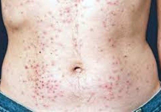 Lesão de pele provocada pelo HIV -  (crédito: Ministério da Saúde)