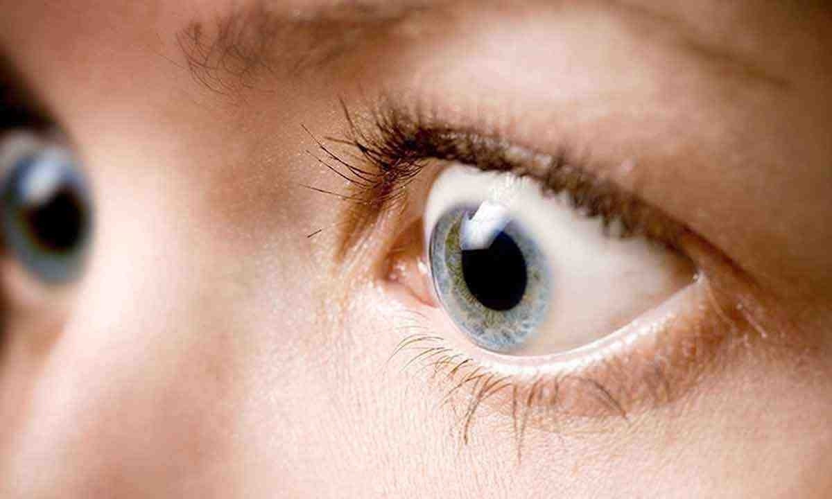 É possível perceber que os olhos do paciente com doença ocular da tireoide saltam para fora -  (crédito: SBPCO/Divulgação)