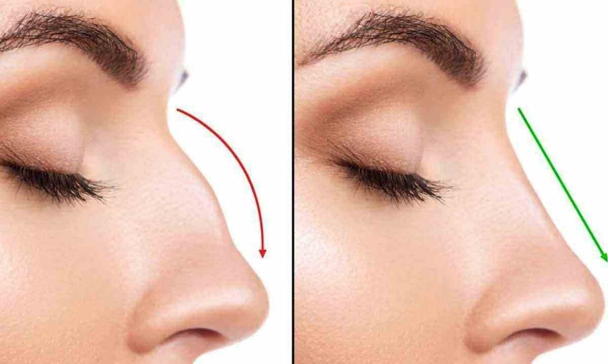  Rinoplastia, ao contrário da rinomodelação, pode trazer resultados mais definitivos aos pacientes
 -  (crédito: internet/reprodução)