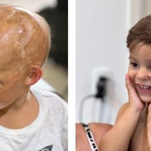 O projeto que recupera a autoestima de crianças que perderam o cabelo em acidentes - Arquivo pessoal/Luciana Rafaela de Lima