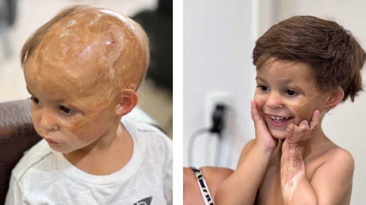 O projeto que recupera a autoestima de crianças que perderam o cabelo em acidentes