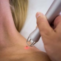 Dezembro Laranja: dermatologista alerta para os riscos do câncer de pele; confira - wavebreakmedia_micro