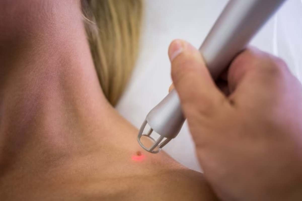 Dezembro Laranja: dermatologista alerta para os riscos do câncer de pele; confira