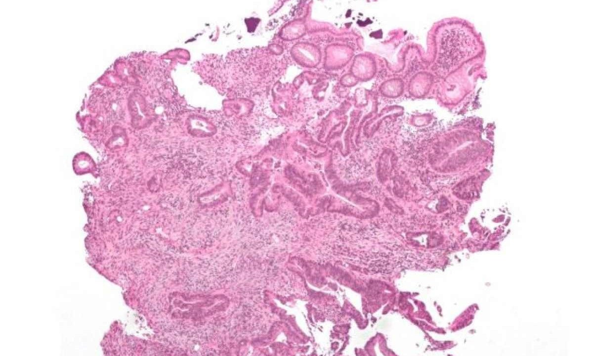 Adenocarcinoma invasivo, o tipo mais comum de cancro colorretal -  (crédito: Nephron/Wikimedia Commons)