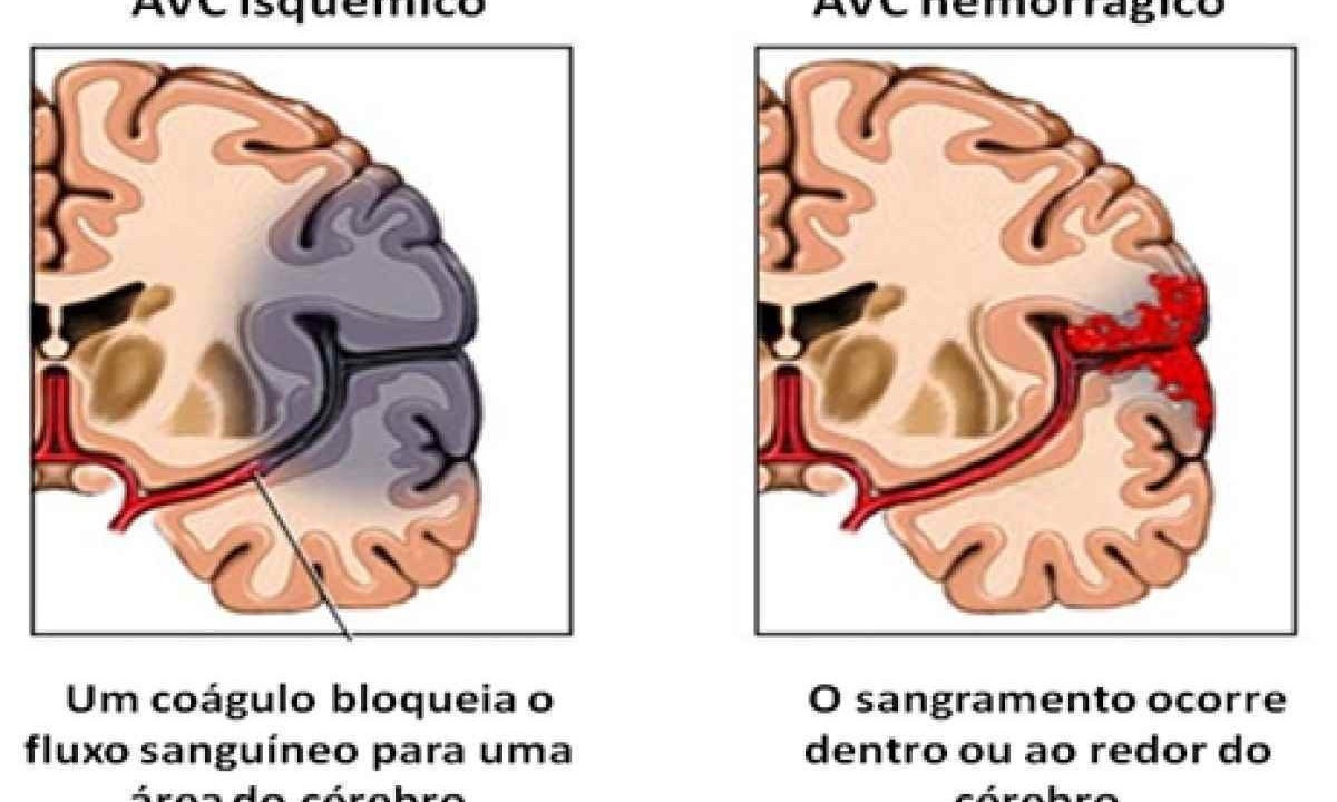  
     -  (crédito: Sociedade Brasileira de AVC)