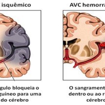 Anticoagulante reduz em 37% risco de AVC em pacientes com doença cardíaca silenciosa - Sociedade Brasileira de AVC