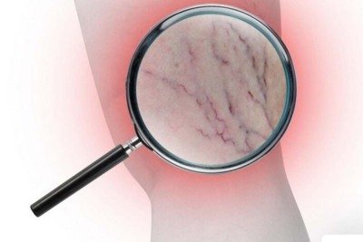 Embora a exposição ao sol não esteja relacionada à piora das varizes, é importante tomar cuidado com o calor, que pode favorecer o inchaço e, consequentemente, o agravamento da condição -  (crédito: Freepik)