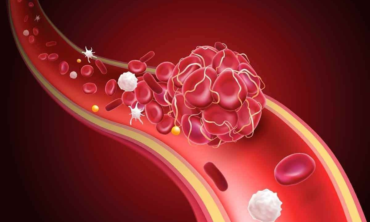 Formação de coágulos leva à trombose e a outros problemas vasculares
 -  (crédito: Reprodução)