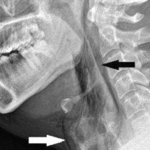 Médicos alertam: homem tem garganta perfurada ao tentar conter espirro   - BMJ