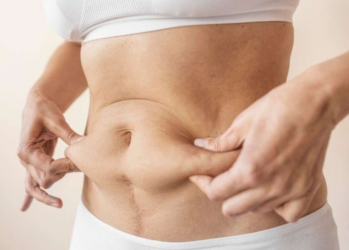 Saiba quais são os tratamentos pouco invasivos  que ajudam a combater a gordura localizada