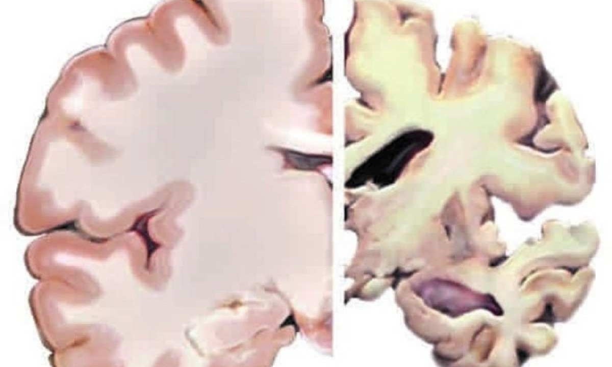 Cérebro saudável (E) e tecidos com lesões relacionadas à demência: estilo de vida influencia na deterioração dos tecidos   -  (crédito: National Institutes of Health/Divulgação )