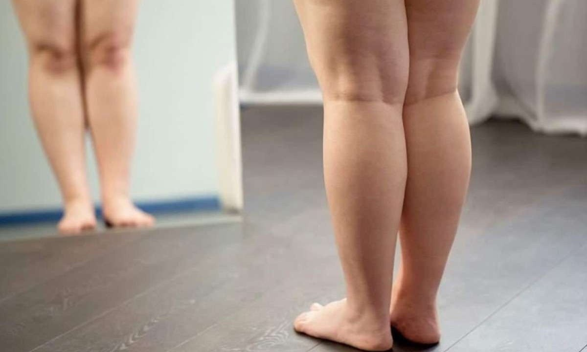 Acúmulo de gordura pode causar uma restrição importante na amplitude do movimento do joelho -  (crédito: Freepik)