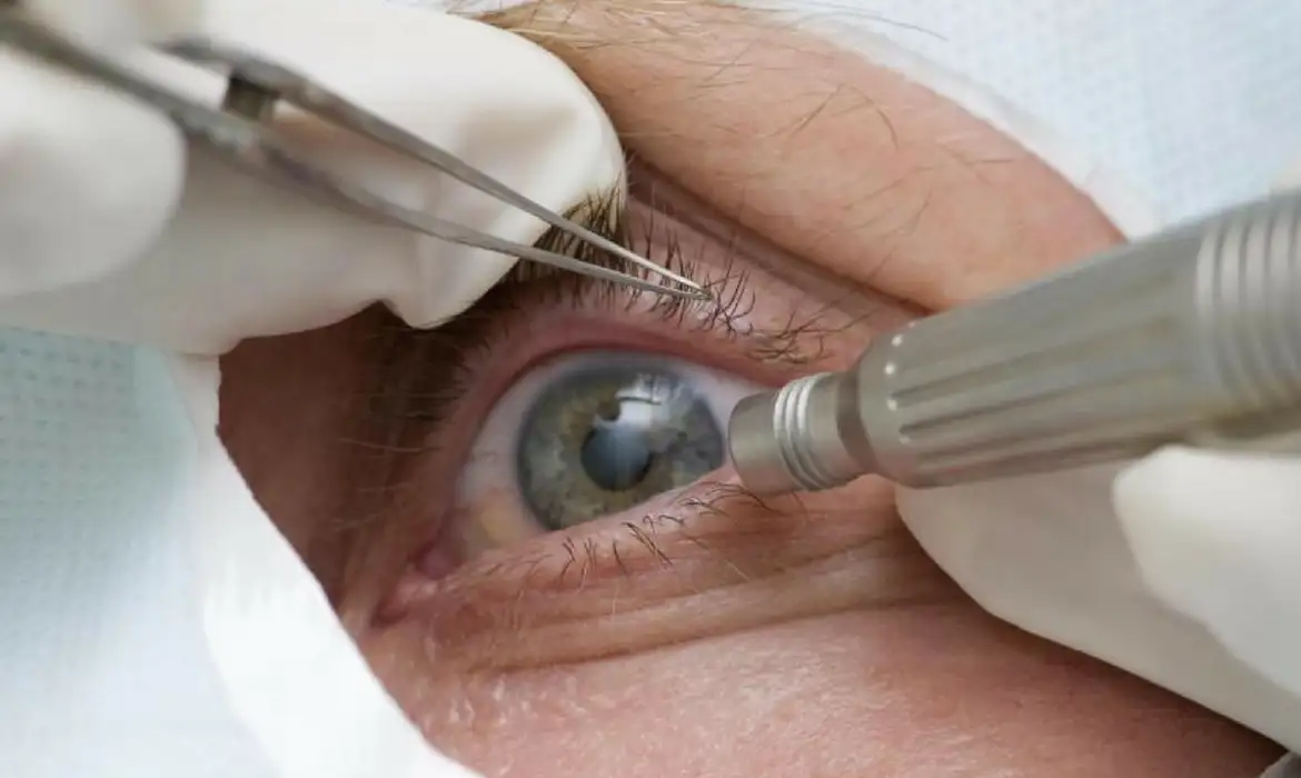 Médicos alertam para riscos de cirurgia de mudança da cor dos olhos -  (crédito: EBC - Últimas Notícias)