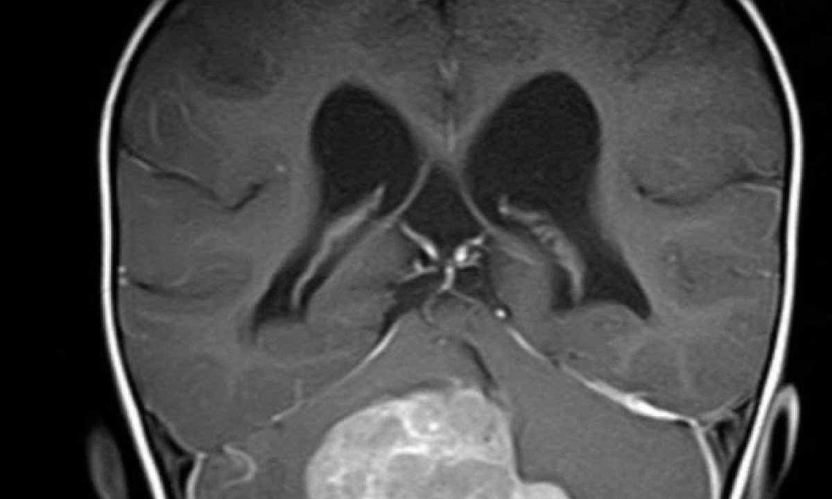 No meduloblastoma com extensa nodularidade (MBEN), pequenas câmaras de tecido são delimitadas dentro do tumor  -  (crédito:  © Ghasemi / KiTZ)