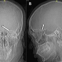 Radiografia mostra prego no cérebro de um homem; caso intriga médicos - Cureus
