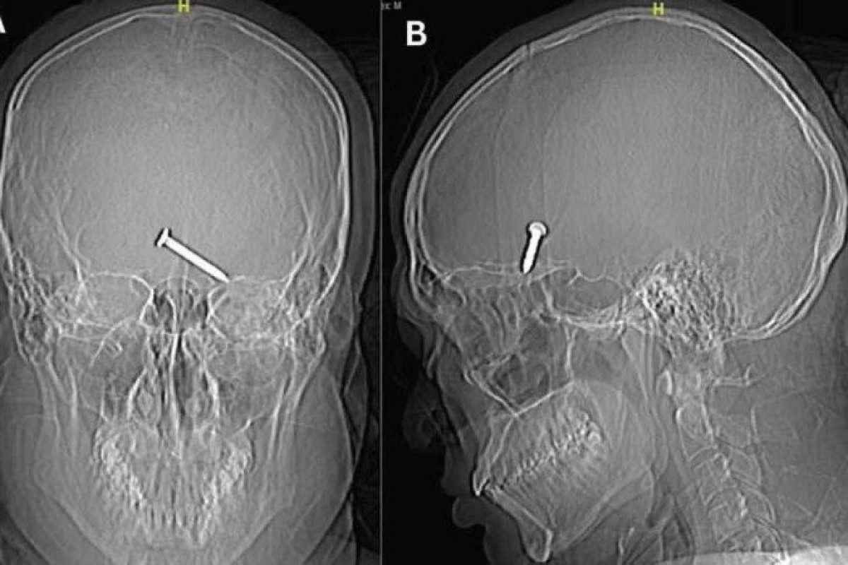 Radiografia mostra prego no cérebro de um homem; caso intriga médicos