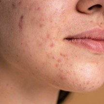 Pessoas com acne enfrentam preconceitos que  prejudicam vida social e profissional, mostra estudo - Freepik