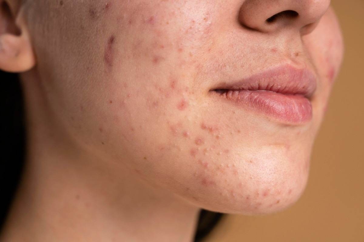 Guia completo da acne: dermatologistas respondem dúvidas