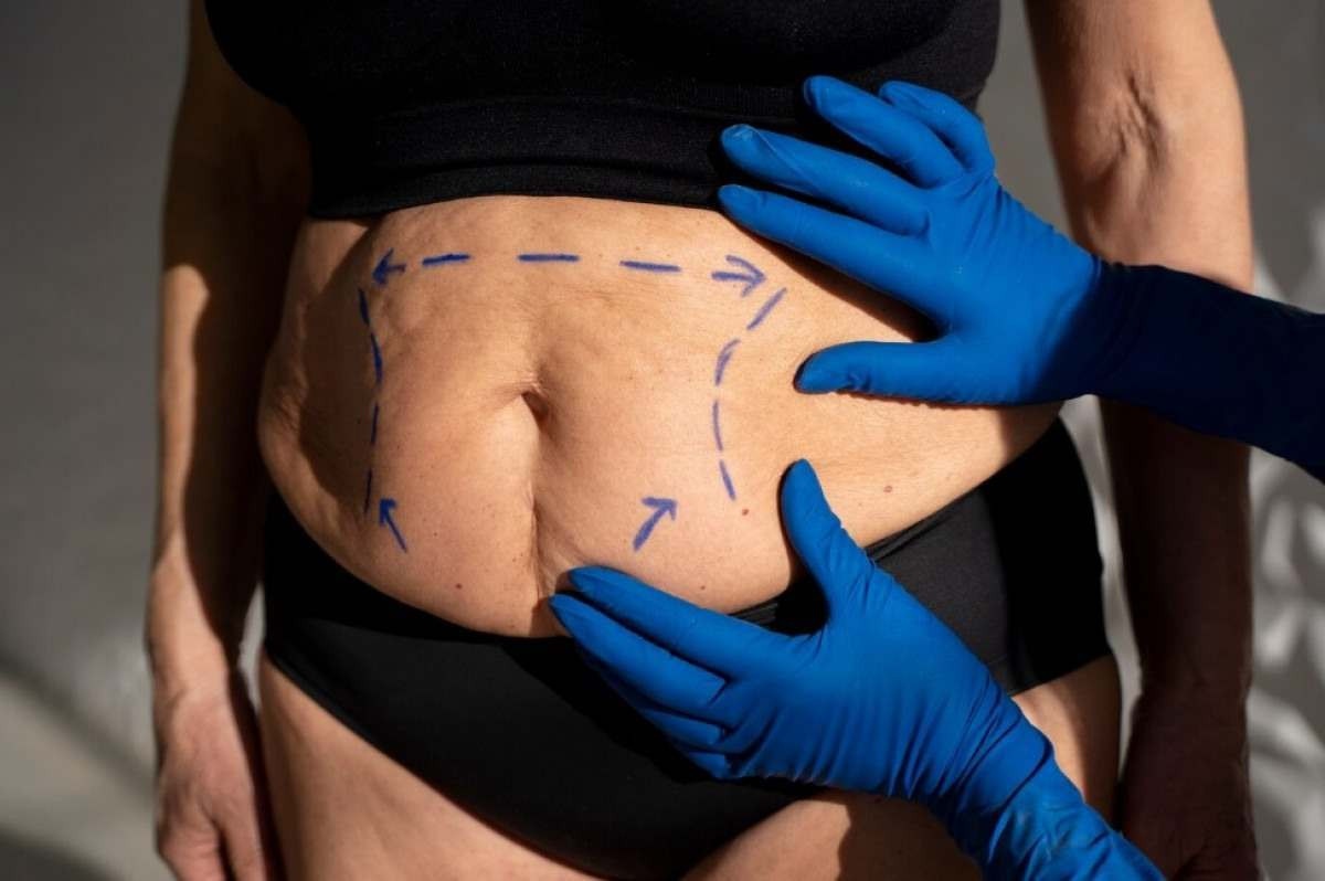 Ex-obeso: cirurgias plásticas reparadoras ajudam na melhora da qualidade de vida