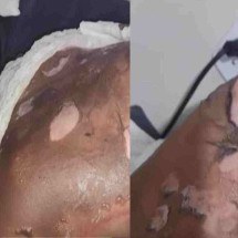 Homem queima 40% do corpo da namorada e é preso - Reprodução/TV Brasília