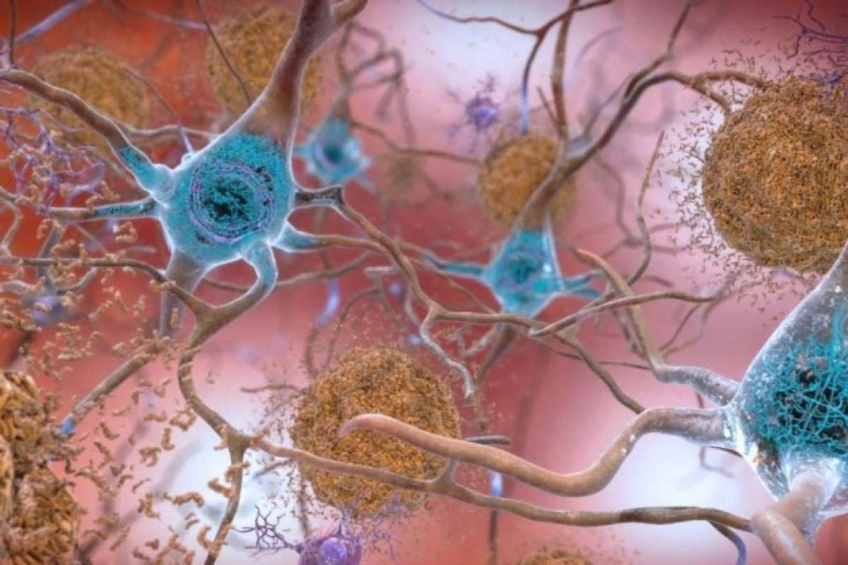 Alzheimer: novo teste promete mais eficácia no diagnóstico