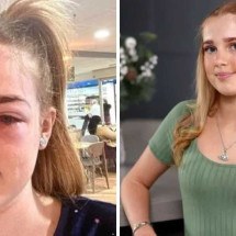 Menina de 13 anos quase fica cega por causa de dica de skincare do TikTok - Arquivo pessoal